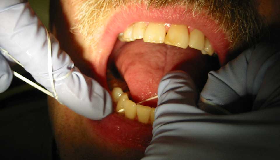 halitosis